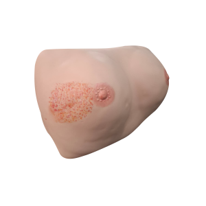 Wearable breast trainer showing palpable benign and malignant tumor locations